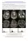 Радиология церебральных глиом: диагностика и мониторинг